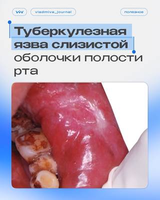 Туберкулезная язва полости рта: ключевые признаки для диагностики.